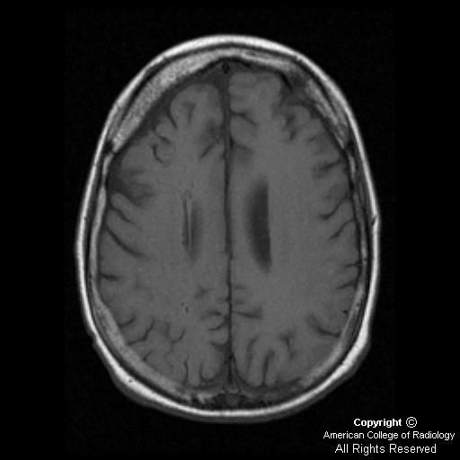 Neuroradiology On the Net SturgeWeber syndrome (SWS)