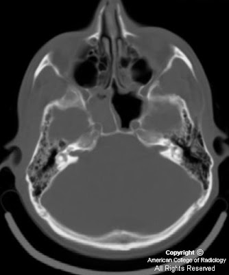 Neuroradiology On the Net: Temporal bone fracture