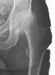Hip joint x-ray before