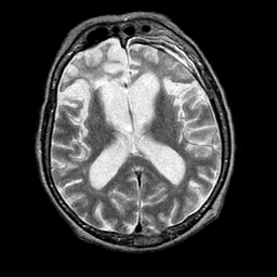 SASI 101InfAux (Santé, assistance et soins infirmiers) Maladie de Pick