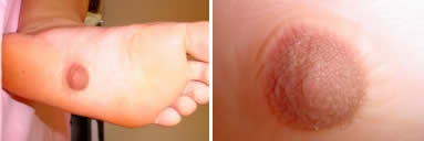 Nipple on the foot