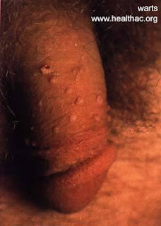 Genital Warts : Symptoms, Causes, and Complications