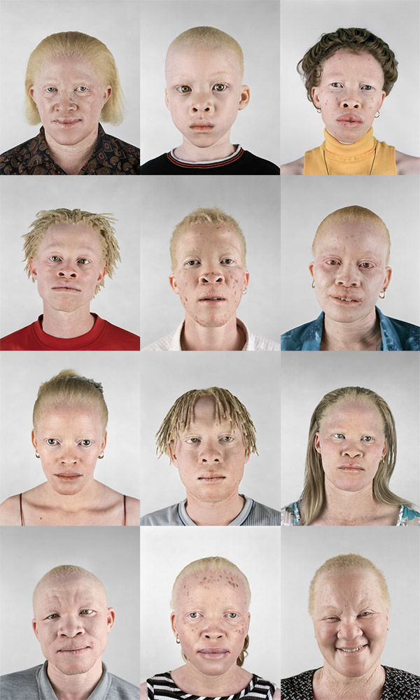 negroid albinos