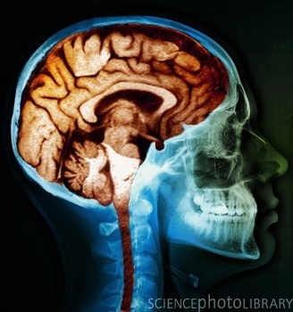 [P332385-MRI_brain_scan_on_skull_X-ray-SPL.jpg]