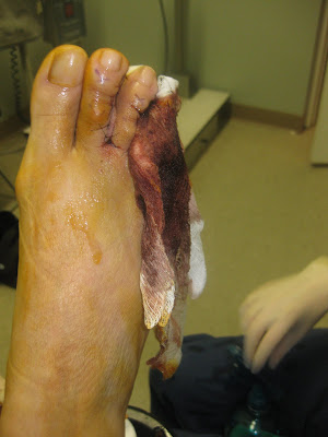 hammertoes holy bandage change surgery hammer toe hammertoe shortening