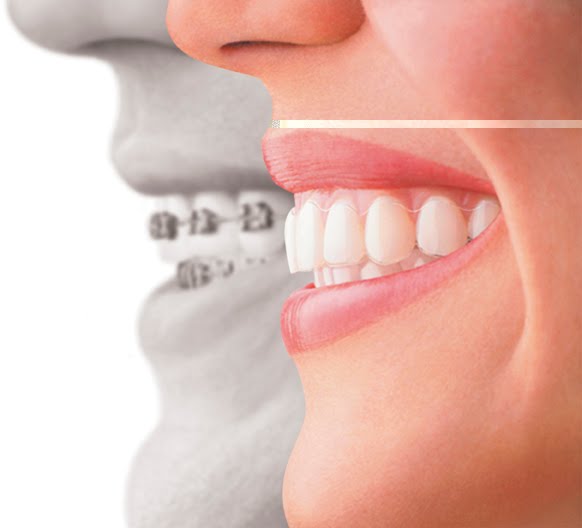 Blanchiment des dents laser Appareils dentaires quasi Blanchiment des dents laser Appareils dentaires quasi