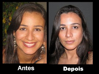 Nariz De Batata Antes E Depois