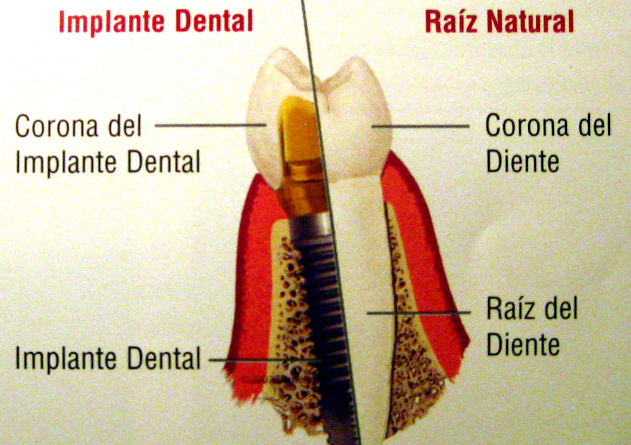 implantes dentales