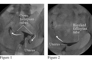 The Adams Home: HSG Hysterosalpingogram