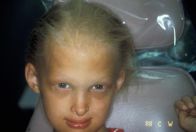 Rx Pics: ECTODERMAL DYSPLASIA