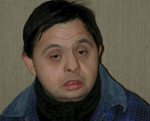 Sindrome+Down.gif