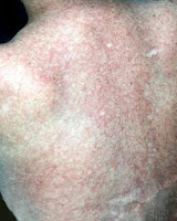Lupus Eritematoso discoide