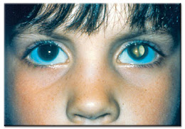 Cataract Congenital (Diwarisi)
