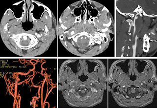 血栓とは何ですか?