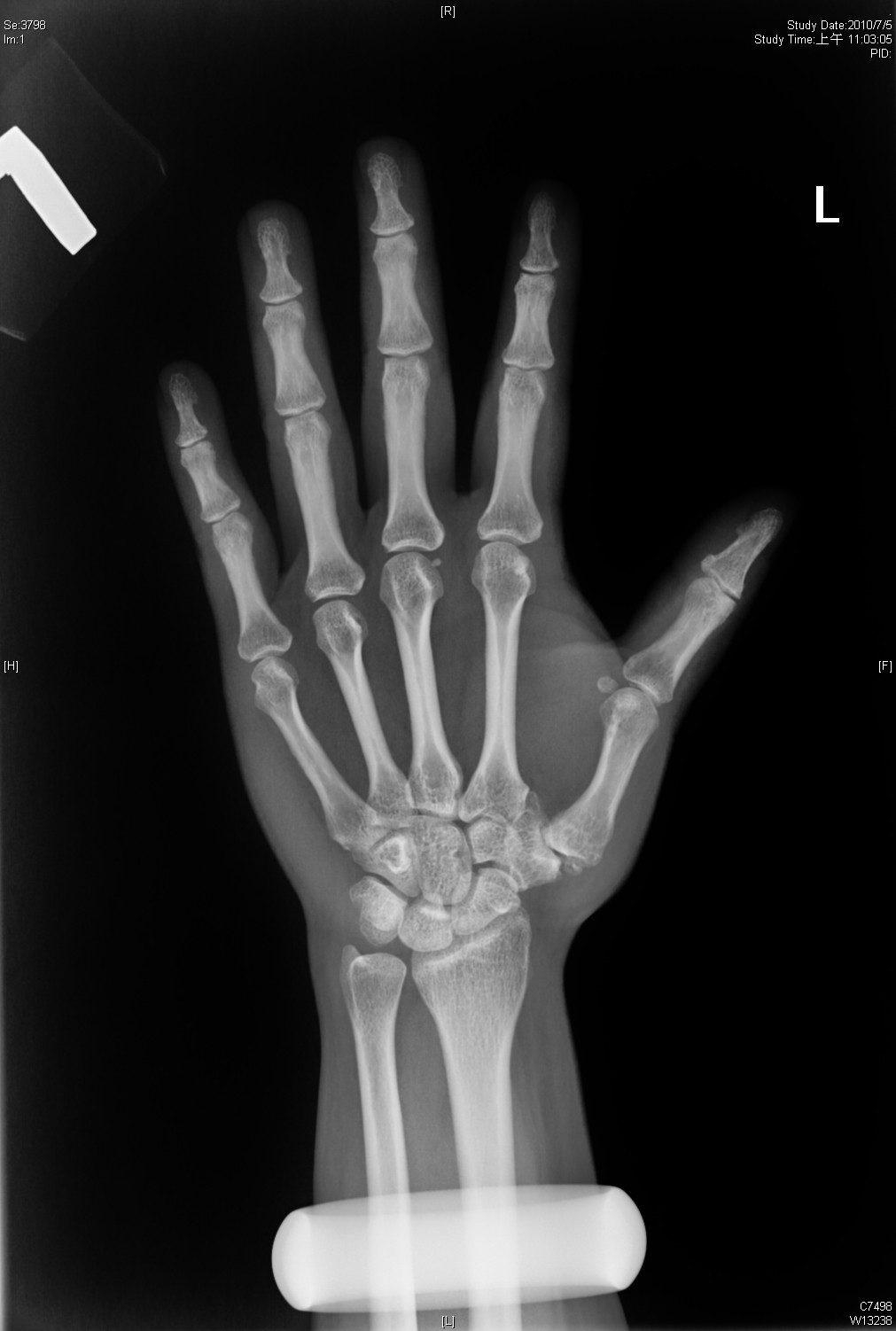 Big Bad Basal joint OA with subluxation