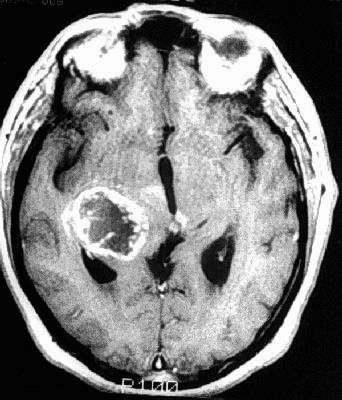UNDERSTANDING MRI: GLIOBLASTOMA MULTIFORME