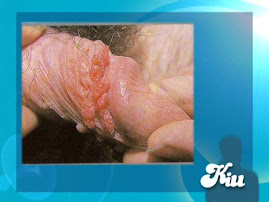 condilomas verrugas vph