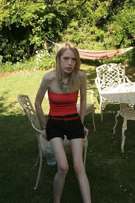 Most Amazing Photos from the World Cultures Horrors of Anorexia