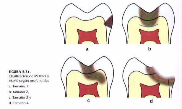 temas odontologicos: clasificacion de G. MOUNT Y R. HUM
