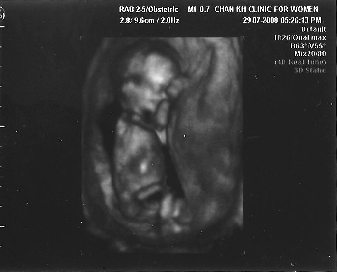 [ultrasound+scan+14+weeks-1.jpg]
