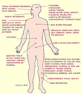 la neurofibromatosis causa pérdida de peso
