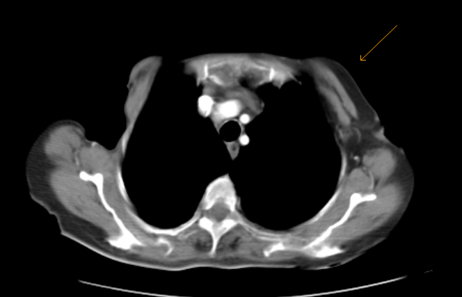 Poland&rsquo;s Syndrome-CT - Sumer&rsquo;s Radiology Blog