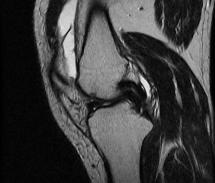 Double PCL Sign-MRI - Sumer's Radiology Blog