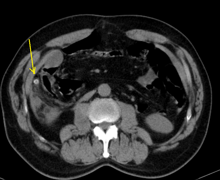 Appendicitis Ct Sumers Radiology Blog