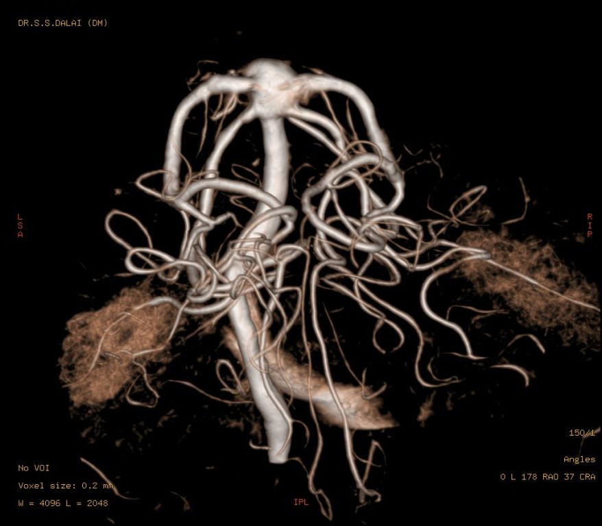 Double stent assisted coiling of a complex basilar top aneurysmVideo
