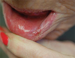 Lip Lesion Excision