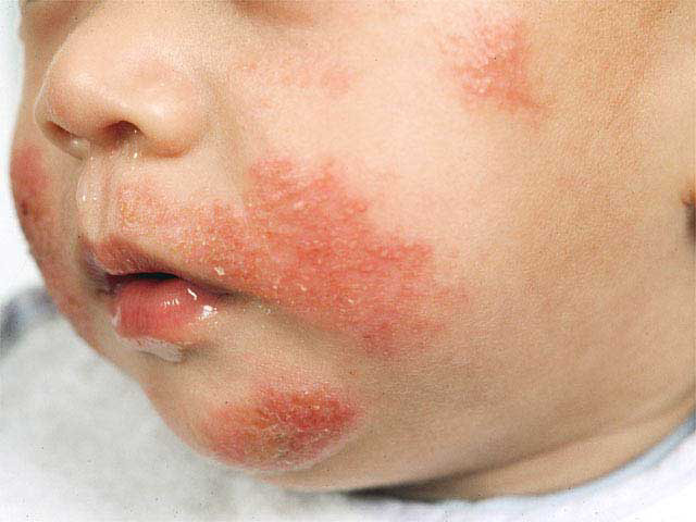 Scarlet Fever In Babies And Toddlers: 9 Answers You Must Know