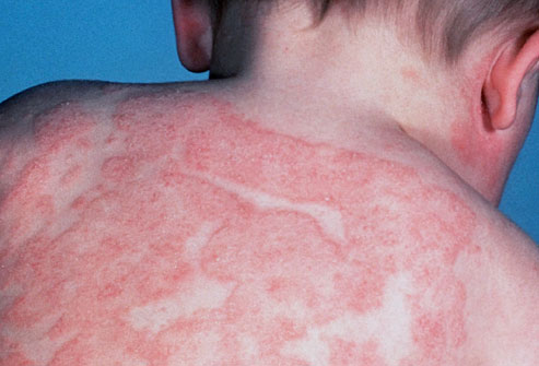 Eczema Treatments for Kids - Verywell - Know More. Feel ...
