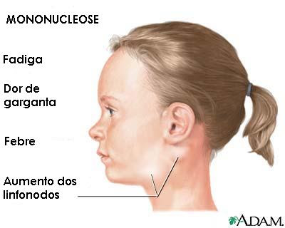 Mononucleose - sinais e sintomas