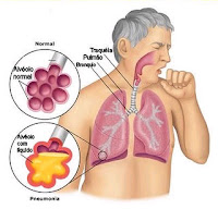 pneumonia sintomas