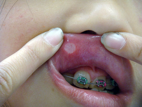 Herpes fotos na boca