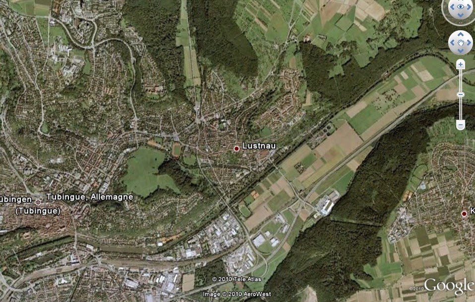 Xray Result Of Pleurodiaphragmatic Adhesion Left