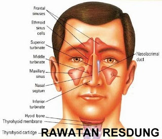 Rawatan Resdung