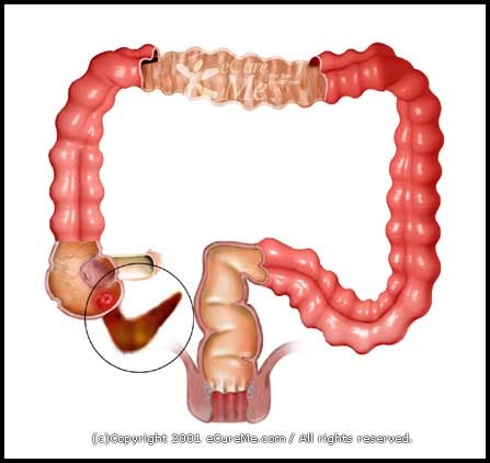 сигмовидная кишка сигмоидит. сигмовидная кишка сигмоидит. сигмовидная кишка 2а. сигмовидная кишка 2а. дивертикулёз сигмовидной кишечник.