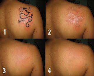 How To Delete A Tattoo: Cryosurgery Tattoo Removal-Easy way to remove