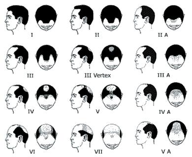 types of male pattern baldness