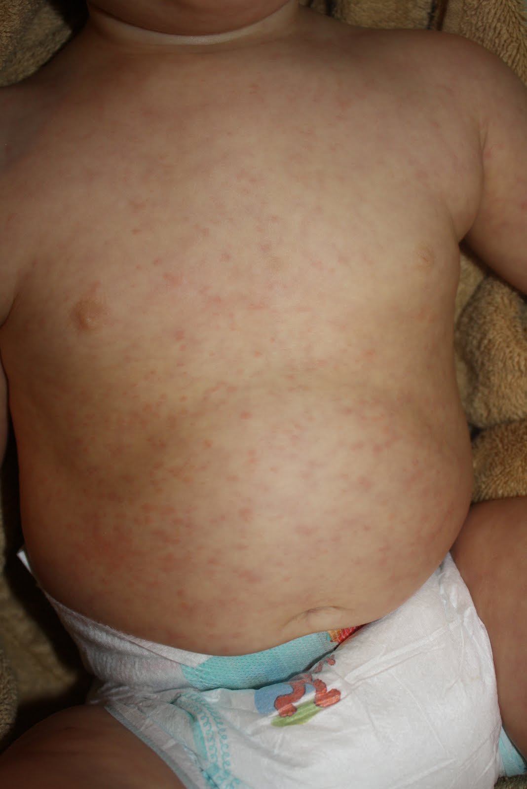 The Salch Family Fifths Disease....