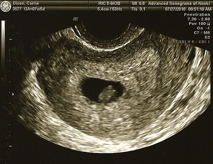 no heartbeat at 6 weeks no heartbeat at 6 weeks