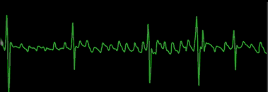 [atrialfib.gif]
