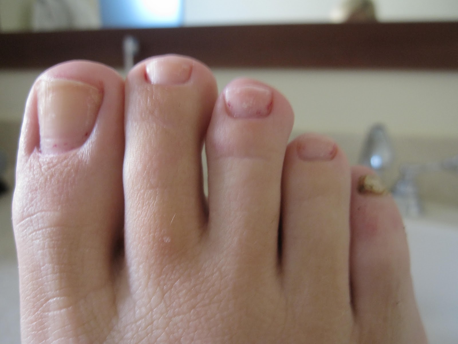 Pinky Toe Nails Black Pinky toenails that are coming off or are