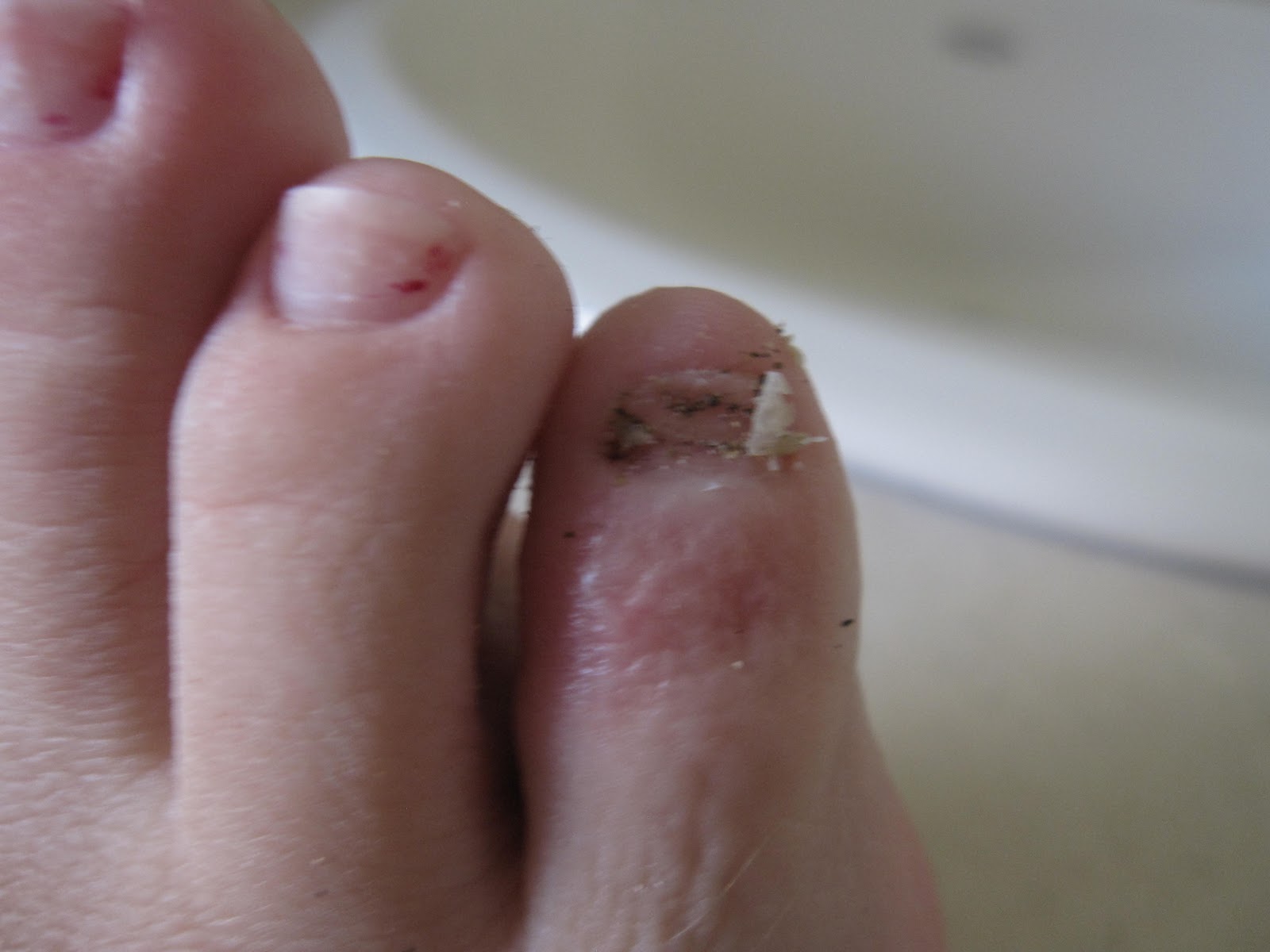 a-lady-reveals-nothing-rip-pinky-toenail