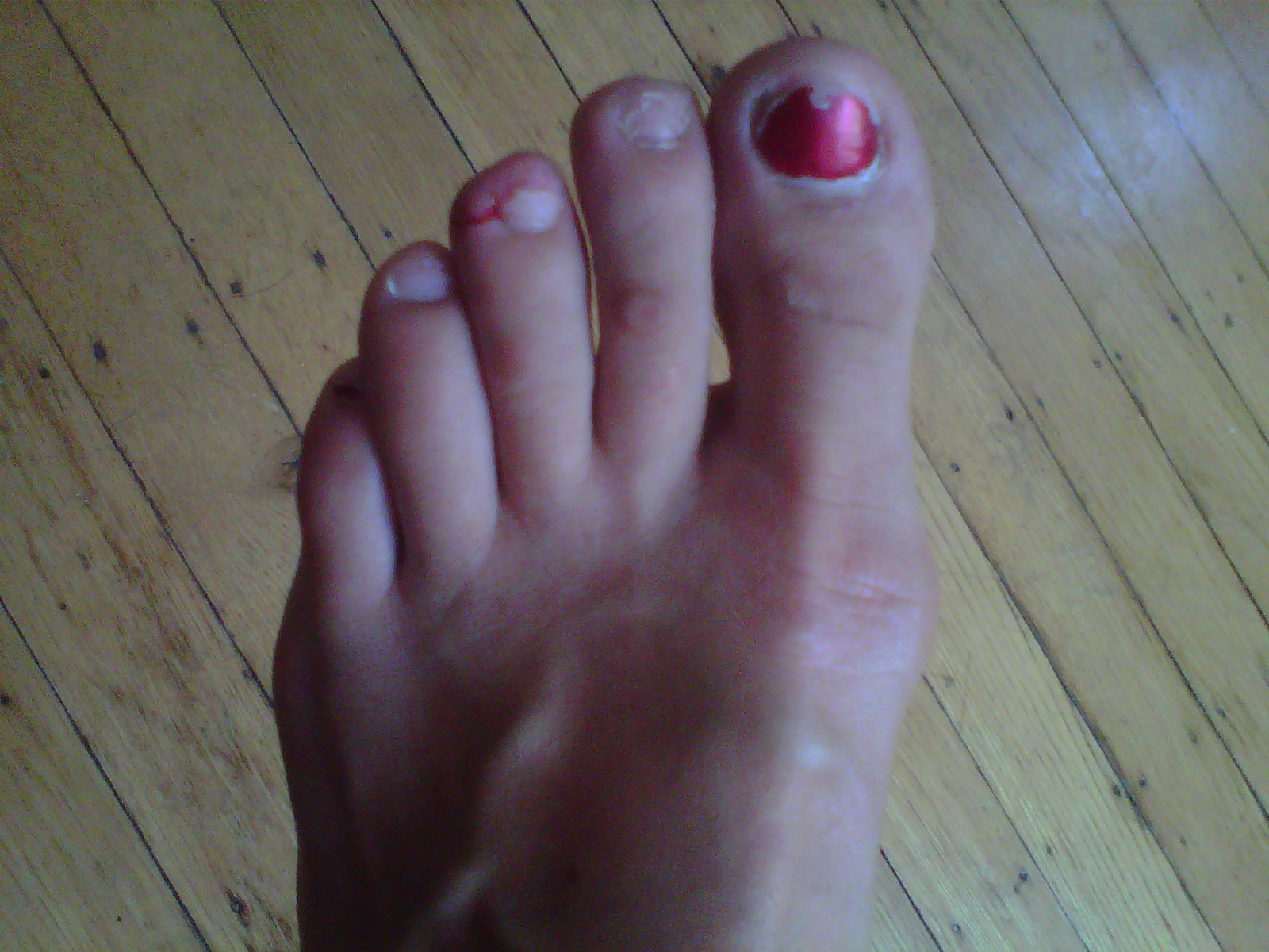 Team Good Grief's Jog Blog: My Toenail Fell Off