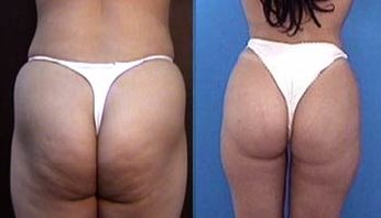 The Buttocks Before & After Weight Loss