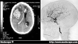 Kathy's MRI Pathology Blog: Saccular Aneurysms