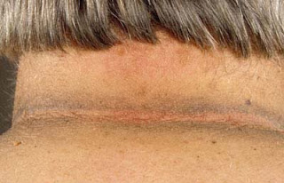 Types of Cancer: Acanthosis Nigricans