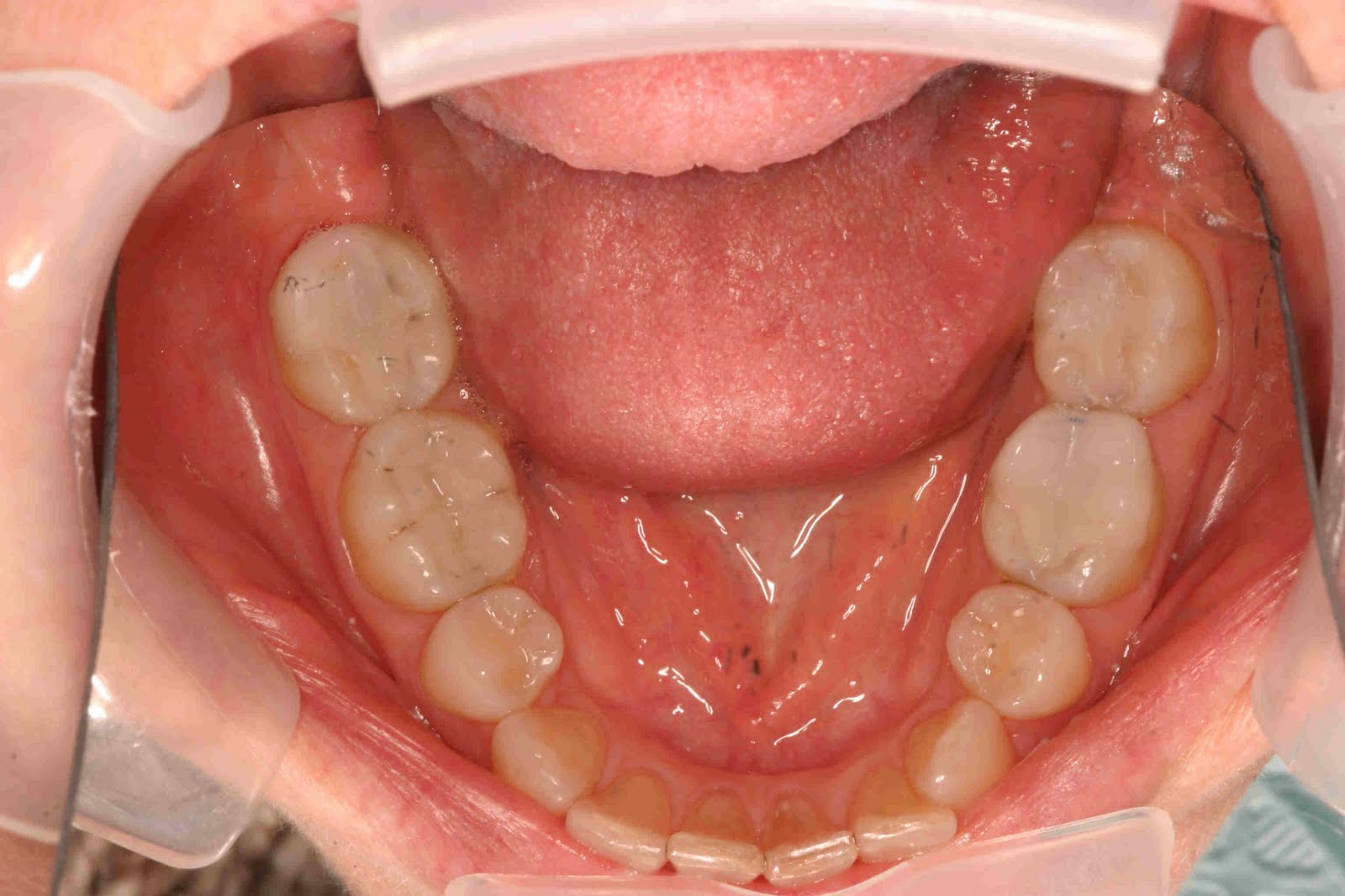 Austin Cosmetic Dentist Lakeway Dentist Dr Tejas Patel Austin